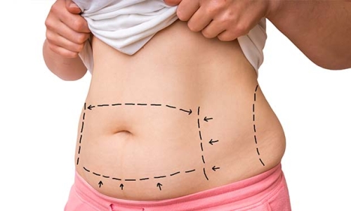 Liposuction Liposuction